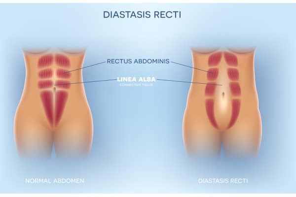What Non-Surgical Options Are Available for Diastasis Recti Surrey?