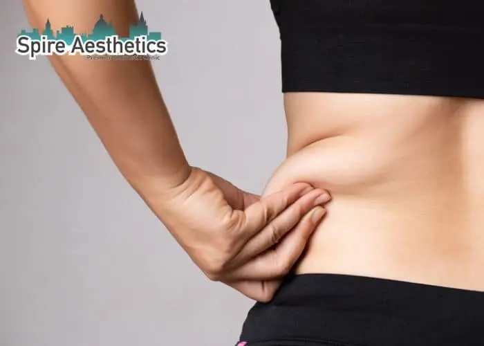 Image of woman pinching fat on their hips Surrey. Fat Freezing treatment