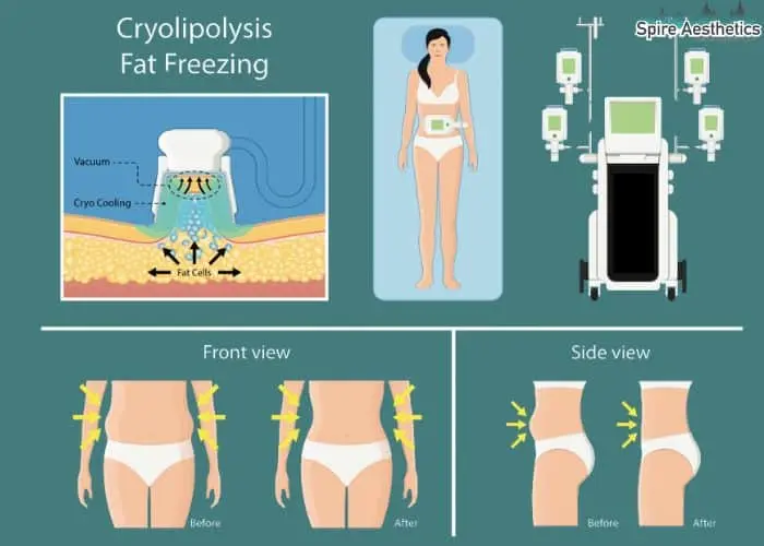Fat freezing treatment Surrey benefits for competitions to remove stubborn fat deposits.