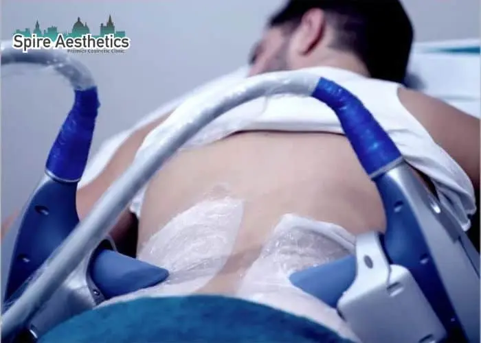 Man having fat freezing treatment done on love handles before a competitions Surrey to create a sculpted look.