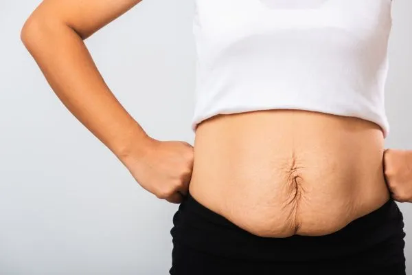 Image of a woman's stomach after weight loss with sagging skin following a gastric band Surrey