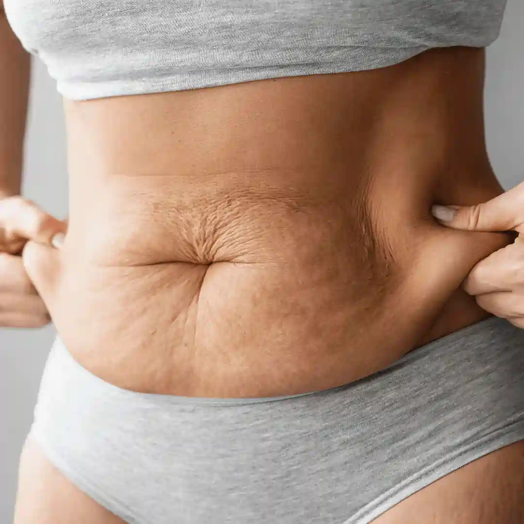 Is It Normal to Have Loose Skin After Pregnancy Surrey?
