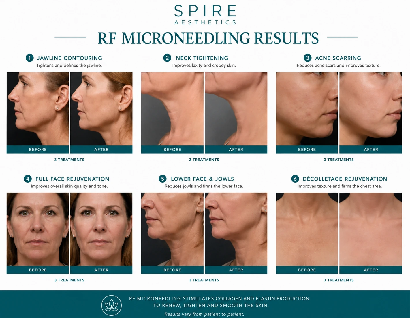 RF Microneedling Skin tightening Surrey results