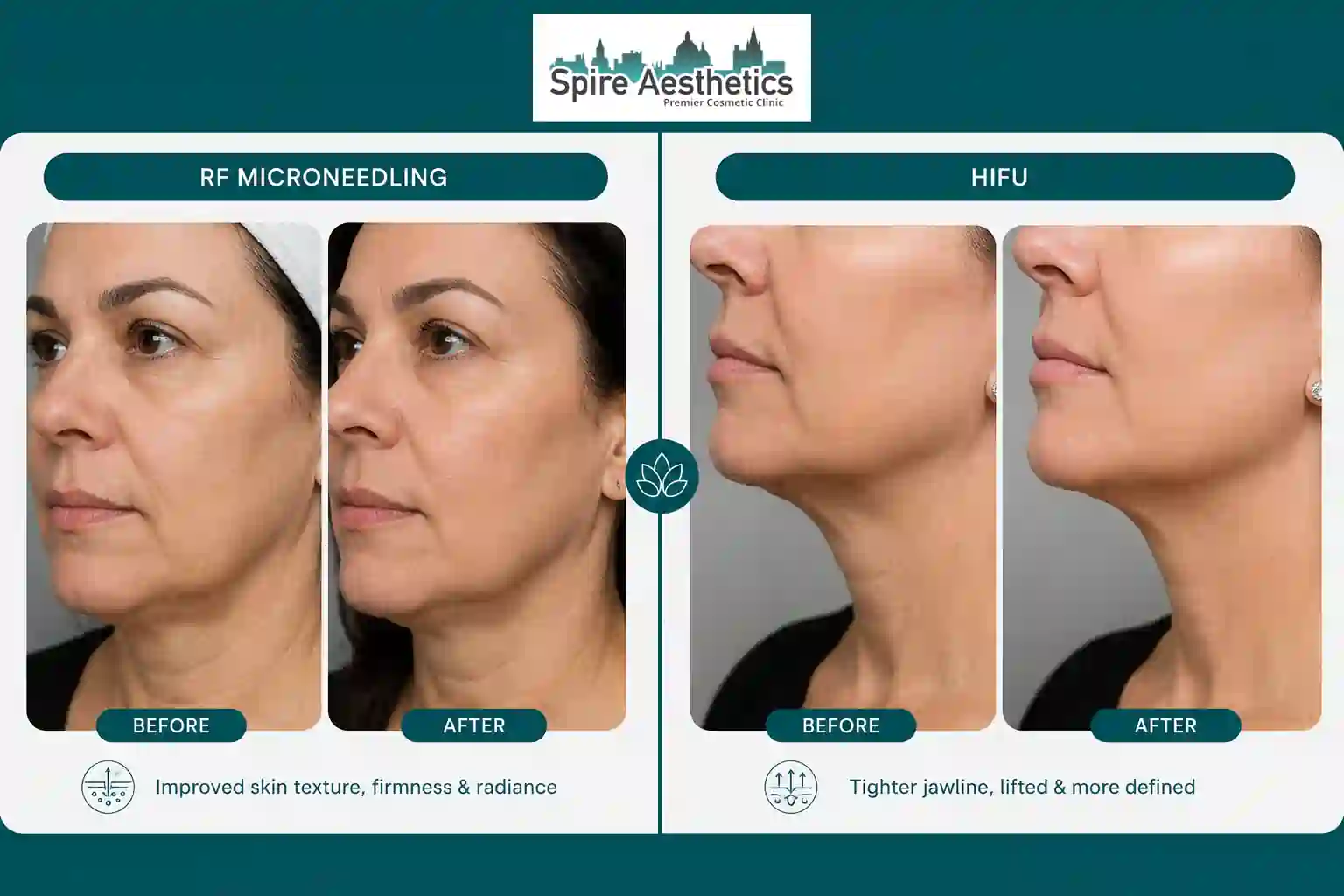 Can RF Microneedling and HIFU Be Combined Surrey?