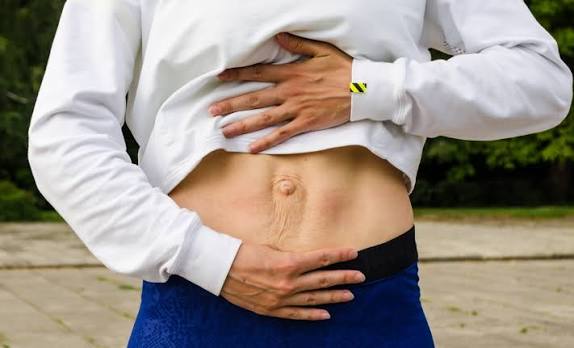 When Could Diastasis Recti Be the Missing Piece of the Puzzle Surrey?