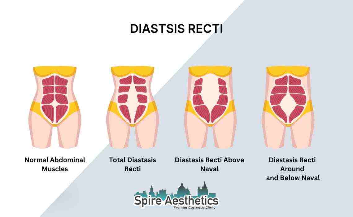 Is Non-Surgical Diastasis Recti Treatment Right for You? Common Concerns Answered Surrey